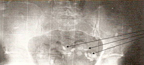 X-ray of undissolved pills in digestive tract